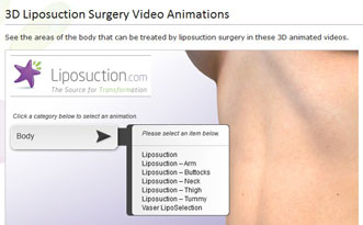 3D Liposuction Surgery Video Animations