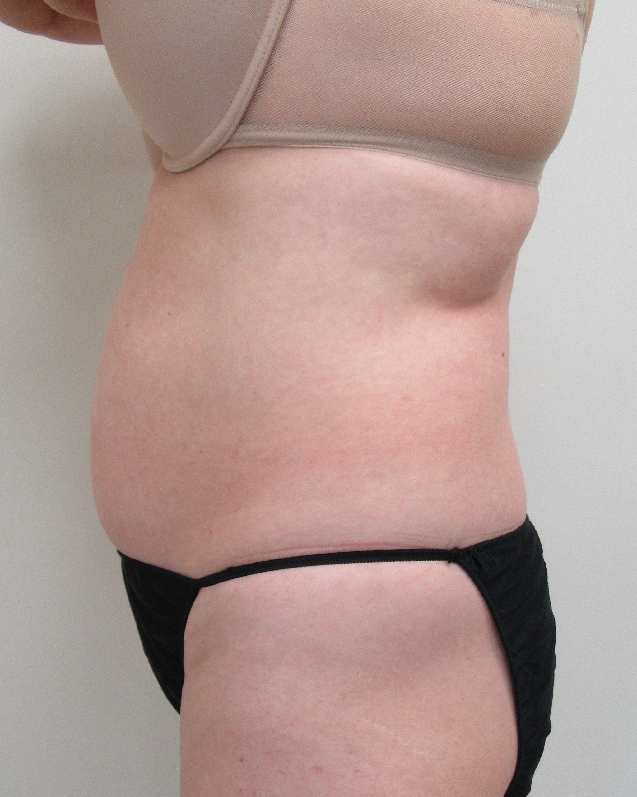 Case 0104 580911, LIPO Abdomen Side View Before