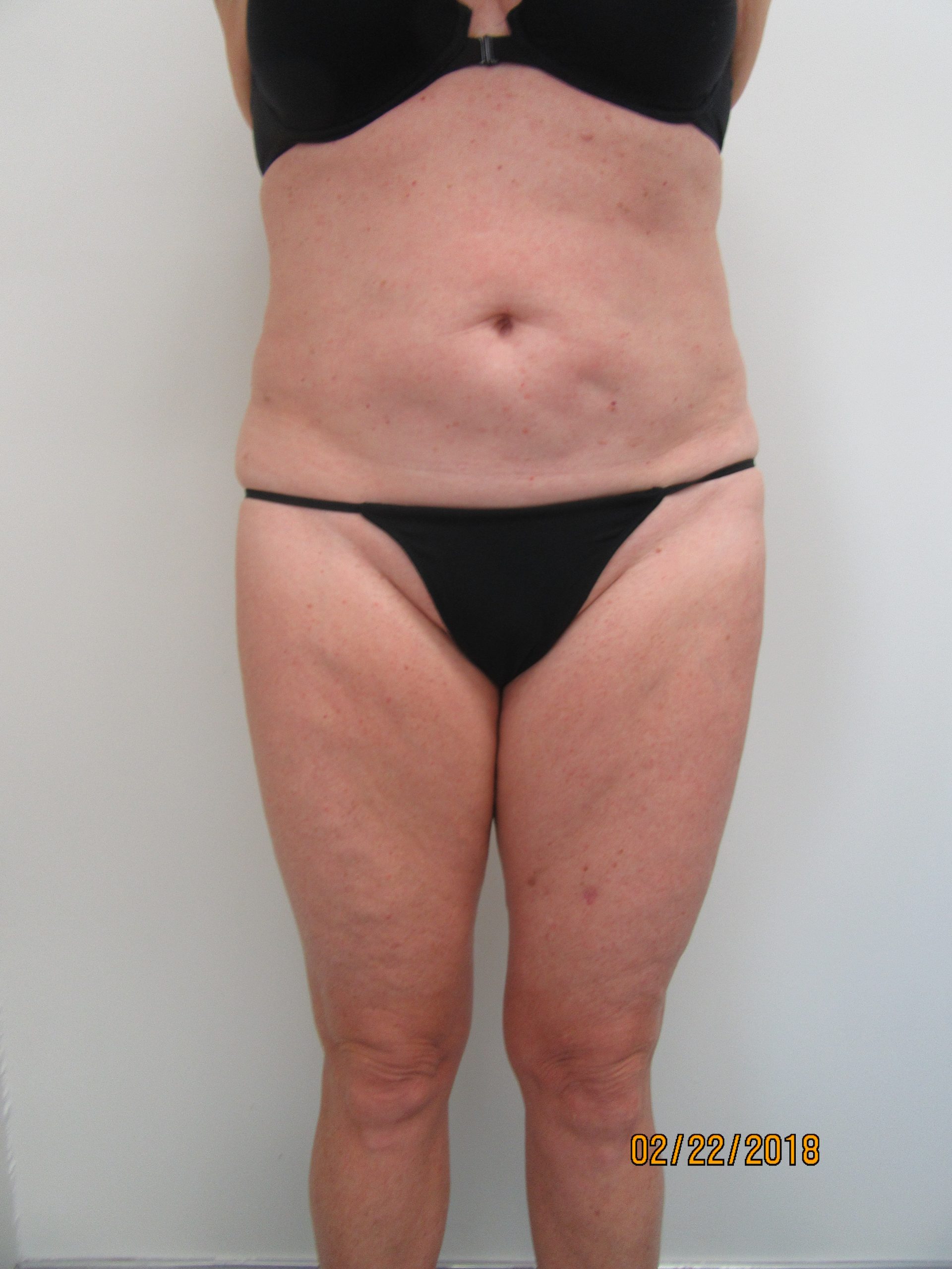 Case 0112 510827, Lipo Abd, IT, IK – before