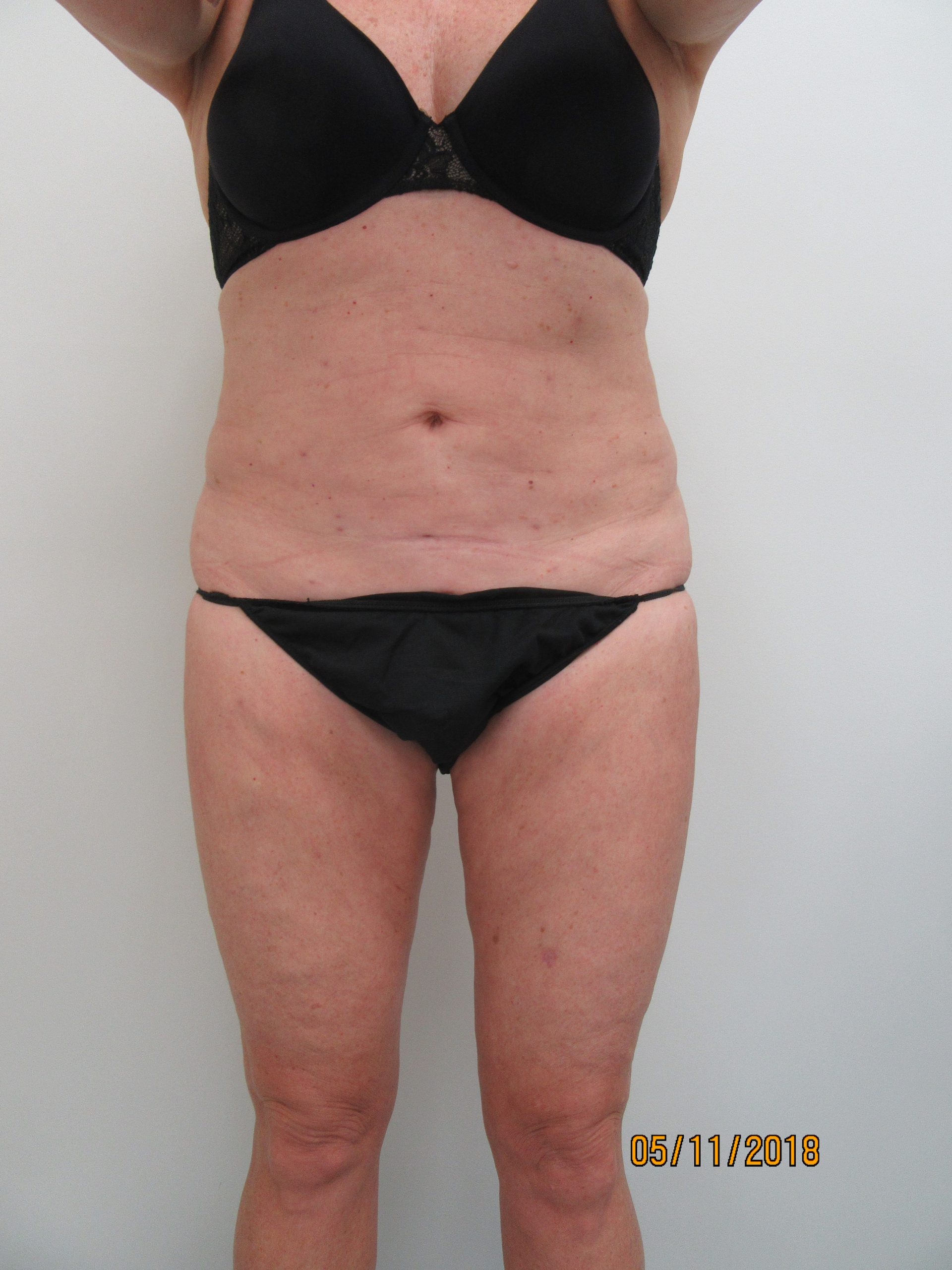 Case 0112 510827, Lipo After Abd, Before IT,IK