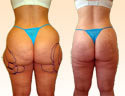 Liposuction Patient Research