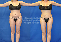 lipo before & after 1