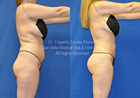 lipo before & after 2