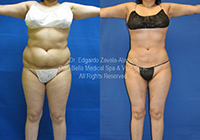 lipo before & after 3