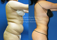 lipo before & after 4