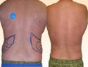 Liposuction Surgeons Research 