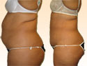 Liposuction Surgery Clinical Trial